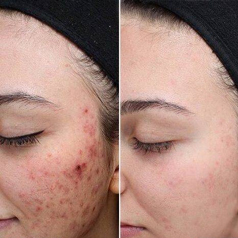 DERMAPLANING and CHEMICAL PEEL